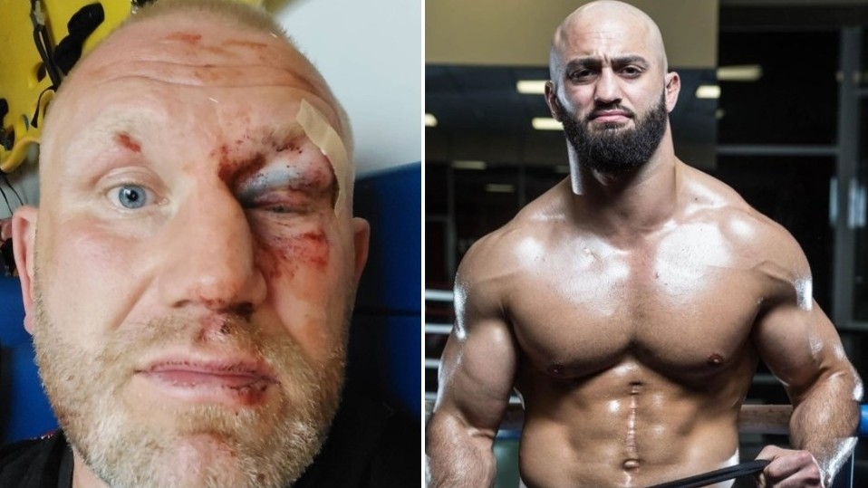 MMA zápasník Sergej Kharitonov po útoku boxerem od Adama Yandieva utrpěl nepříjemné zlomeniny v obličeji