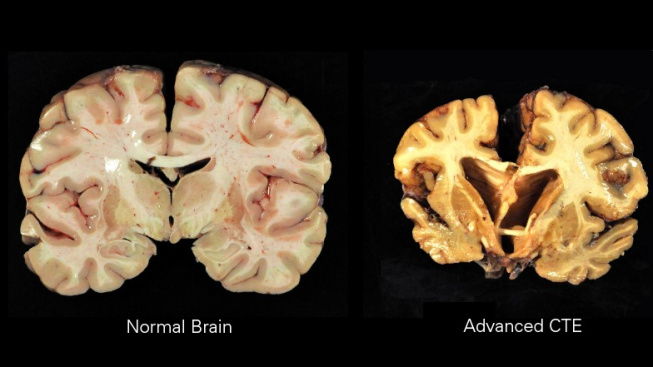 Normalní mozek - Pokročilé CTE